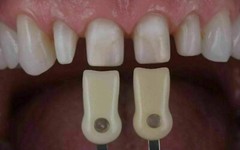 Ivoclar Vivadent Dental Shade Guide A-D 20 IPS or Natural Die ND1-9 Bleach Teeth