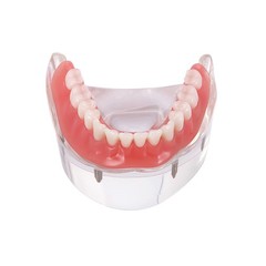 US Dental Implant Teeth Model Overdenture Restoration With4 Implants Upper Lower