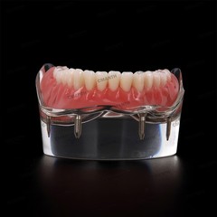 US Dental Model Removable Overdenture Teeth Upper/Lower Jaw 4 Implants Model