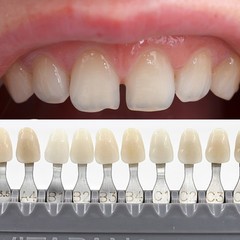 Vita Classical Shade Guide Dental Materials A1-D4 16 Colors Teeth Whitening