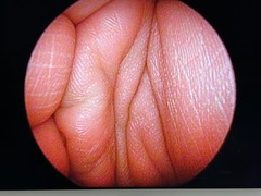 Stryker 502-104-030 Ideal Eyes 4.0mm 30° Arthroscope