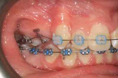 J&J Ortho Orthodontic ABRAM Eruptor Button Tube (10/pk) Esmail Equivalent