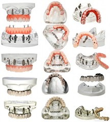 Dental Implant Model Upper Lower Jaw Demo All on 4/6 Overdenture treatment model