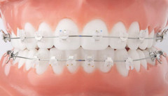 Orthodontic Self-ligating Brackets Ceramic Metal Braces Empower Clear Roth MBT
