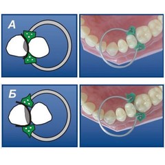 Dental Sectional Contoured Matrices Matrix Ring No.1.398 lm +Add-On Wedges+Plier