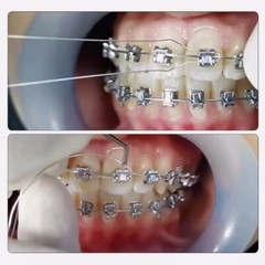 Dental Orthodontic Kobayashi Preformed Wire Metal Ligature Ties Short Long Twist