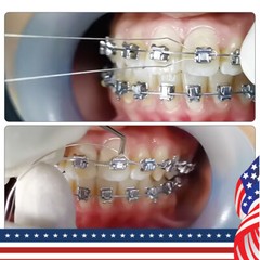 Dental Orthodontic Wire Preformed/Kobayashi Ligature Ties Stainless Steel AZDENT