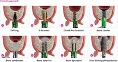Implant Crestal Approach Sinus Surgical Drill Neobiotech SCA 3S Membrane Lifter