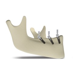 1x Dental Implant Angle Attachment Measure Angulation Implant Gauge Clip