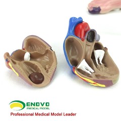 Medical Anatomical Human Diabetes Model 8 Parts Shows The Harm Of Diabetes