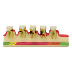 Dental Pathological Typodont Teeth Model Periodontics/Implant/Endodontic Caries