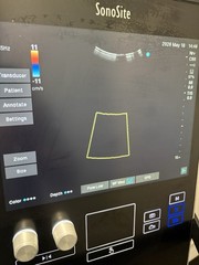 Sonosite SII Total Ultrasound System Ref P20883-12 With Three Probes (PLS READ)