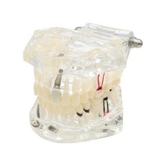 Dentalmall Dental Oral Typodont Model Implant Standard Size, Clear