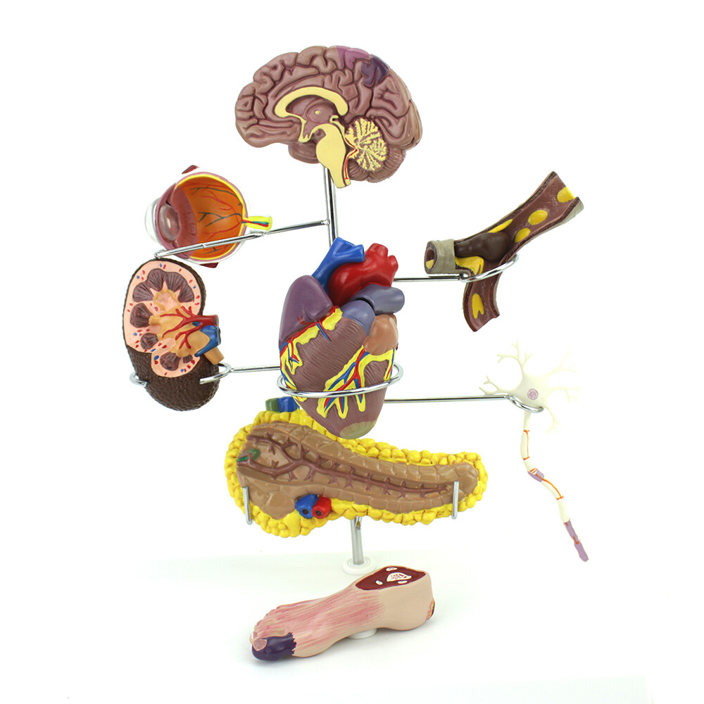 Medical Anatomical Human Diabetes Model 8 Parts Shows The Harm Of Diabetes