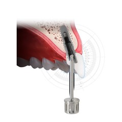 US Dental Lab Screw Driver lmplant Abutment Hex Hand Tool For ITI DIO Straumann