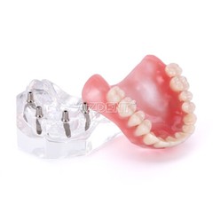 Modelo Demostración Implantes Dentales Sobredentadura Rehabilitada Sup/Inf 2 y 4
