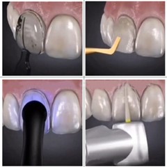 1Kit-30Pcs Dental Composite Resin Veneers Mould Light Cure Anterior Front Teeth