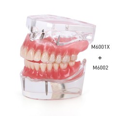 Modelo Demostración Implantes Dentales Sobredentadura Rehabilitada Sup/Inf 2 y 4
