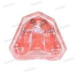 Dental Overdenture Implant Teeth Model Denture with implant Demonstration Pink