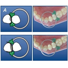 40Pcs Dental Silicone Add-On Wedges Disposable Delta Tine Wedges for Orthodontic