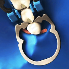 Dental Titanium Ring Stainless Matrices Clamp Separator Matrices Forcep Tweezer