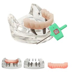 Dental Implant Model Upper Lower Jaw Demo All on 4/6 Overdenture treatment model