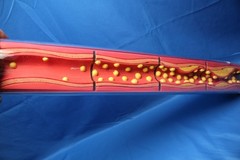 Edco Health Education Silent Destruction: How High Cholesterol Destroys Arteries