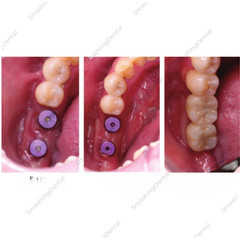 Dental Healing Abutment Healing Closure RC/NC Fit Straumann ITI Bone Level
