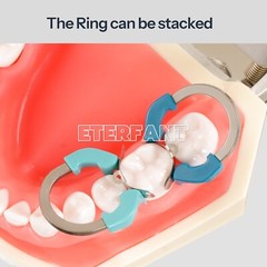 Dental Autoclavable separator rings Bands Matrices Clip Ni-Titanium Fit V3 ring