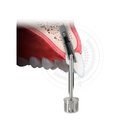 Dental Angled Implant Screwdriver Angulated Screw Channel Driver Hiossen/ITI/NOB