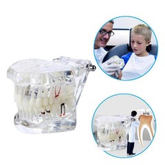 Dentalmall Dental Oral Typodont Model Implant Standard Size, Clear