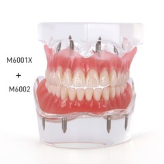 Modelo Demostración Implantes Dentales Sobredentadura Rehabilitada Sup/Inf 2 y 4