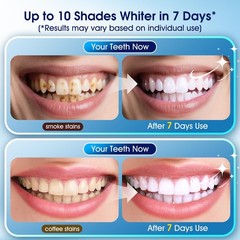 Teeth Whitening Kit: 3 Whitening Pens & 2 Desensitizing Pens + LED Light
