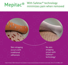 Molnlycke Mepitac Soft Silicone Tape, 0.8″ x 3.3 Yards – Damaged box