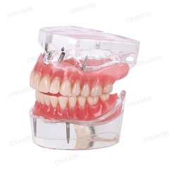 US Dental Model Removable Overdenture Teeth Upper/Lower Jaw 4 Implants Model