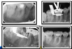 Dental X3 Endo Rotary File Root Canal Curval File Endodontic NITI file21/25/31mm