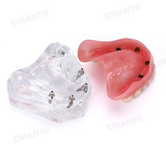 US Dental Model Removable Overdenture Teeth Upper/Lower Jaw 4 Implants Model