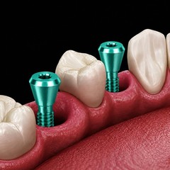 Dental Healing Cover Screw Closure Caps Fit Hiossen/Nobel/Straumann Mini/Regular