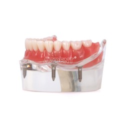 Modelo Demostración Implantes Dentales Sobredentadura Rehabilitada Sup/Inf 2 y 4
