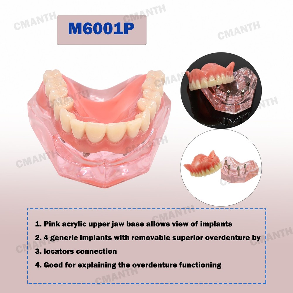 Dental Overdenture Implant Teeth Model Denture with implant Demonstration Pink