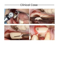 Dental Bone Collector Drill SLT Semilunar Technique Bone Harvest GBR Drill USA