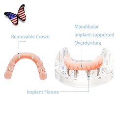 US Dental Overdenture/Implant/Orthodontic Typodont Ortho Training Teaching Model