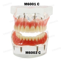 US Dental Model Removable Overdenture Teeth Upper/Lower Jaw 4 Implants Model