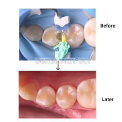 Dental Matrices Clear BT Posterior Molar Posterior Distal Contoured M4.5
