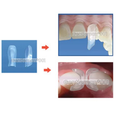 TOR VM 4Size Dental Clear Matrix Matrice Anterior Matrices BT Fit Bioclear L/M/S