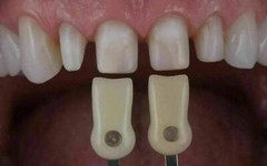 Dental IPS Natural Die Material Shade Guide Ivoclar Vivadent ND1-9 Abutment