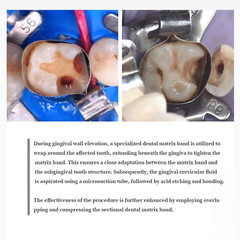 Dental Universal Matrix Band Tofflemire Stainless Steel Matrice Forming Pieces