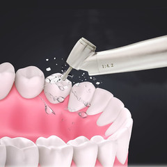 DMXDENT Dental 1:1/1:4.2 /1:5 Contra Angle Fiber Optic LED Low Speed Handpiece