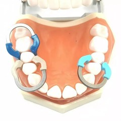 3 Size Dental Matrix Bands Ring Sectional Matrice Clamp Fit Garrison Palodent V3
