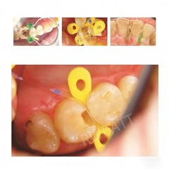 30Pcs Dental Clear Matrix Polyester Transparent Sectional Contoured Matrices